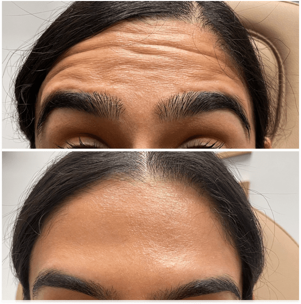 Botox injectors