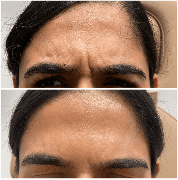 Botox services