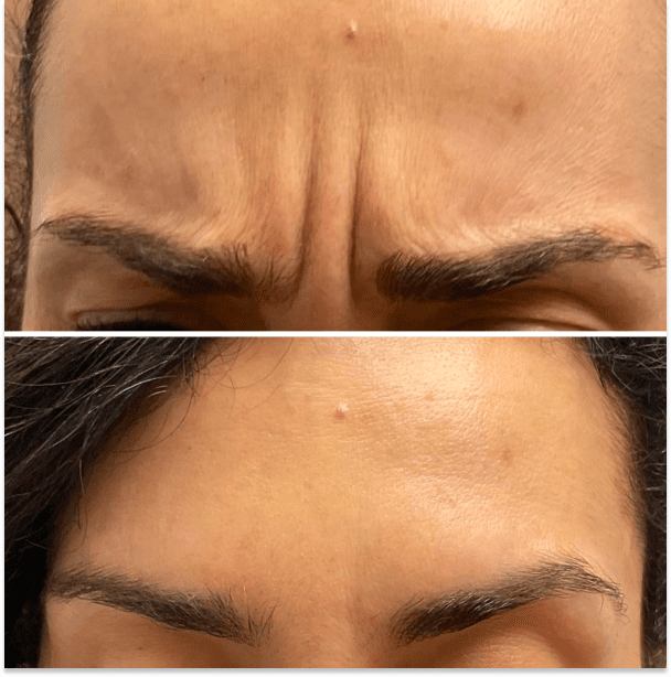 Botox