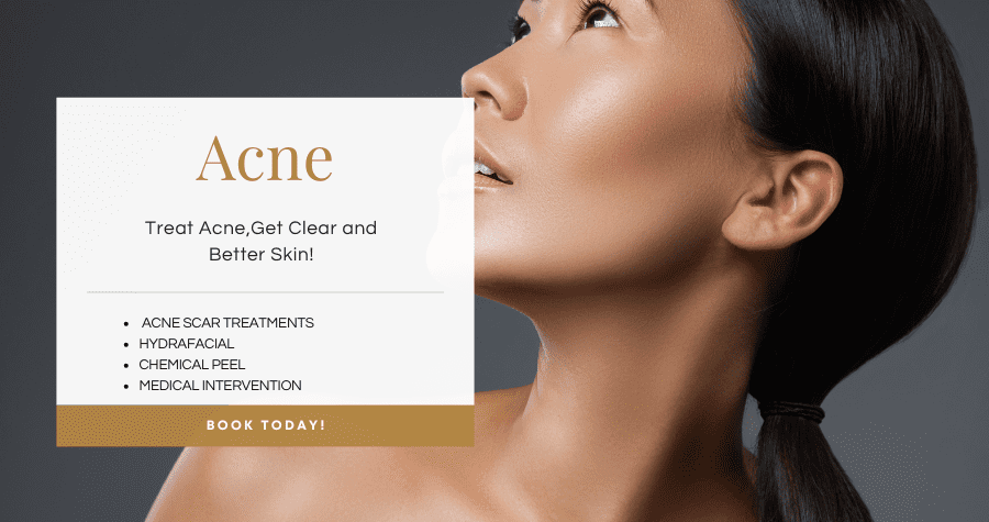 Acne Services