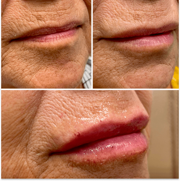 Fillers