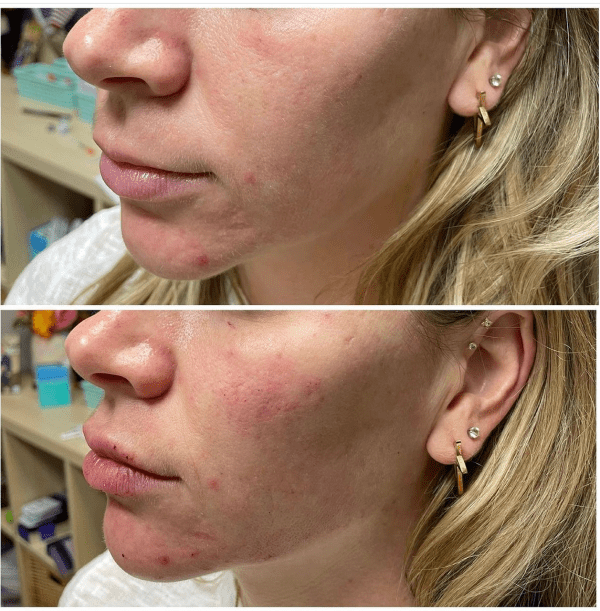 Injectables
