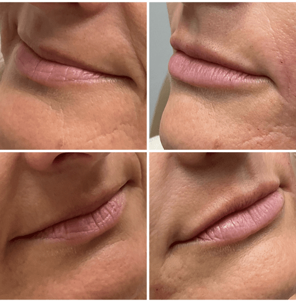 Injectables