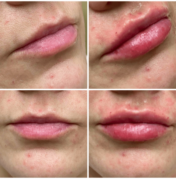 Fillers