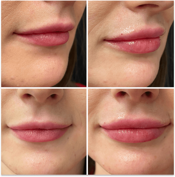 Fillers