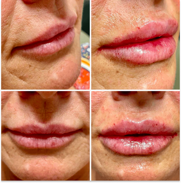 Fillers