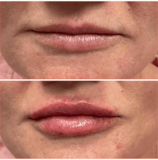 Fillers
