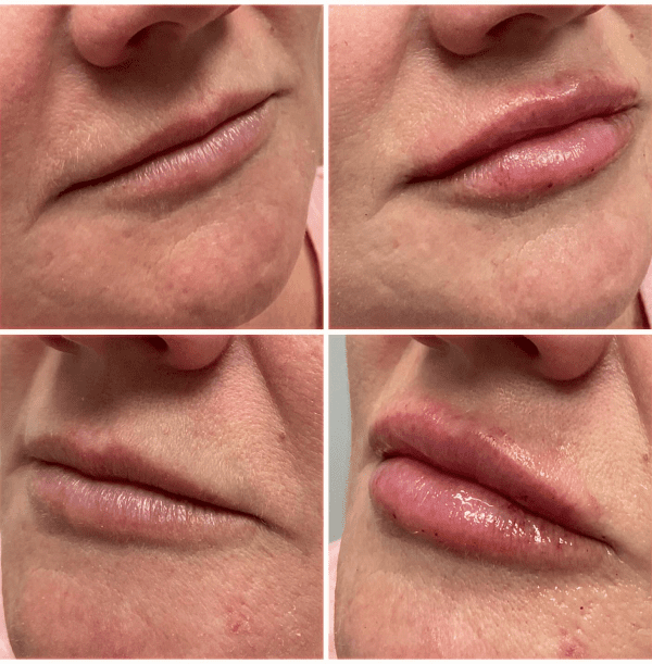Fillers