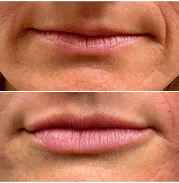 Injectables-Filler-9