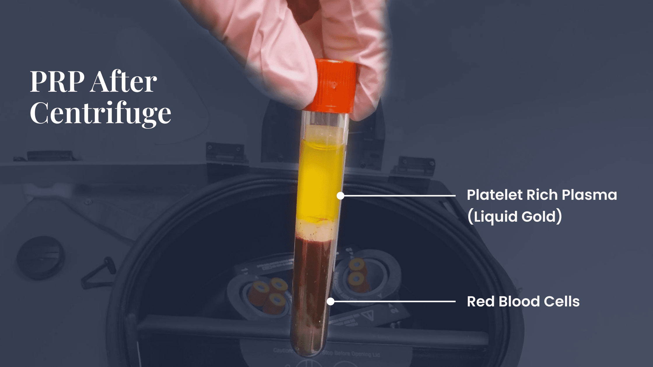 PRP After Centrifuge_