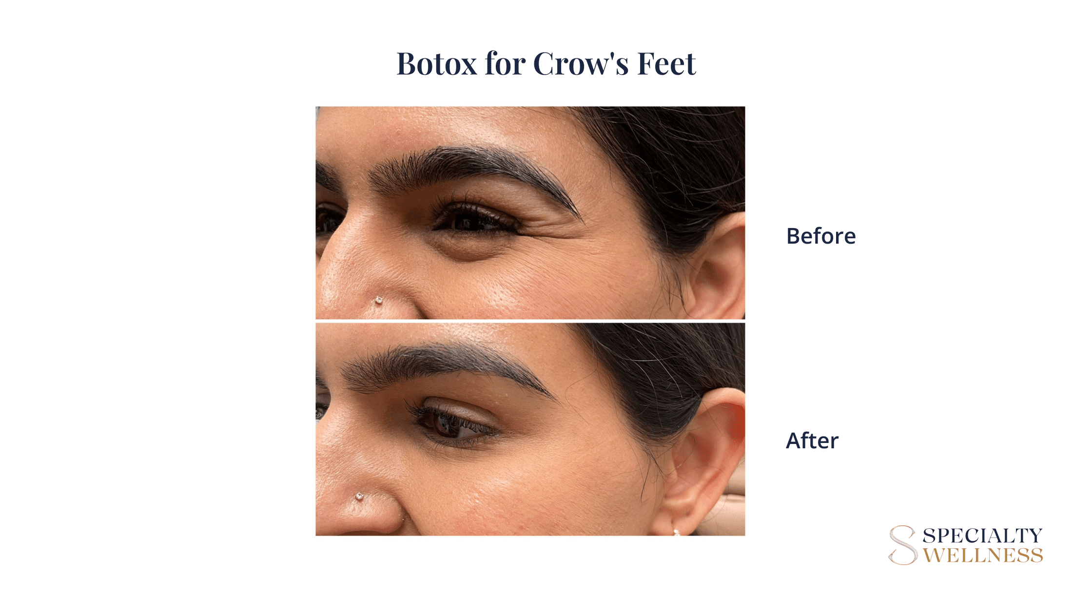 Botox for Crow’s Feet