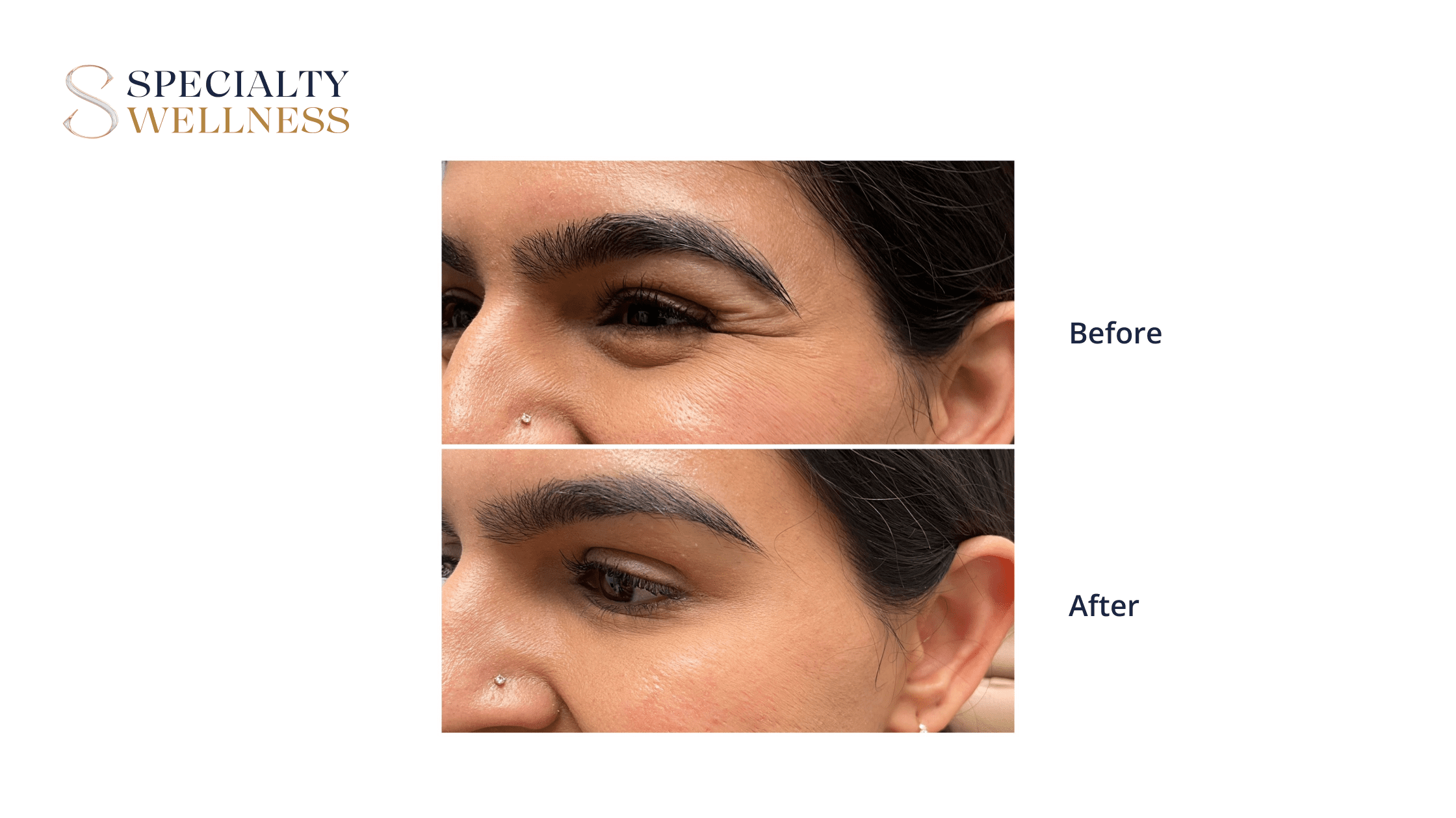 Results You Can Anticipate from Botox for Crow’s Feet with Specialty Wellness