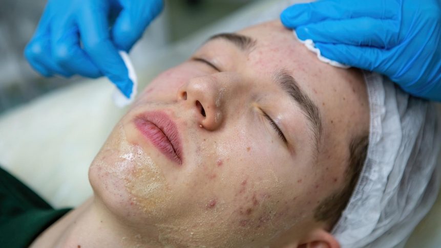 Chemical peels for acne treatment in The Colony TX