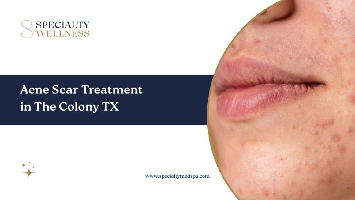 Acne Scar Treatment in The Colony TX: Restore Smoother, Healthier Skin Texture