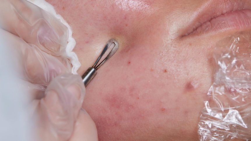 Acne scar treatment in The Colony TX at Specialty MedSpa
