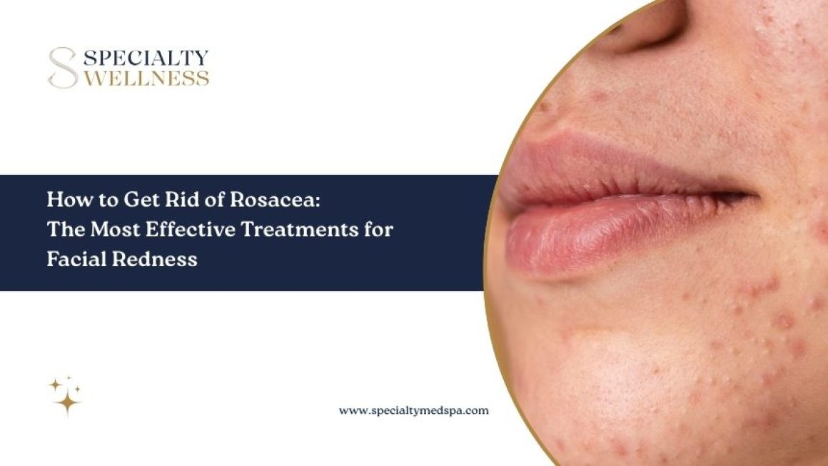 How to Get Rid of Rosacea: The Most Effective Treatments for Facial Redness