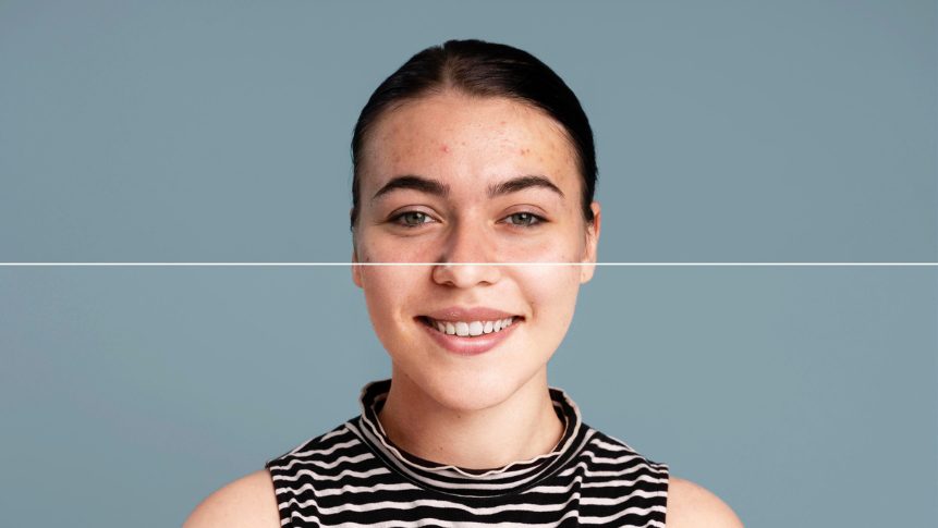 Pigmentation and melasma treatment before and after results in The Colony TX