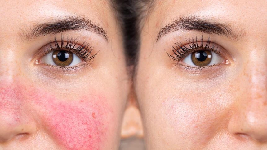 before and after results how to get rid of rosacea redness with laser