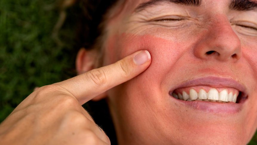 Sun damage and age spot treatment in The Colony TX at Specialty MedSpa