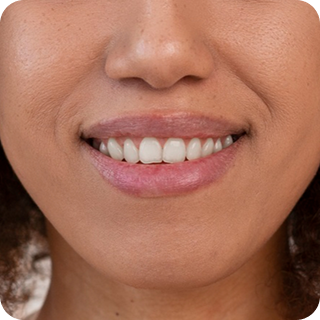 Smile Lines before (1)