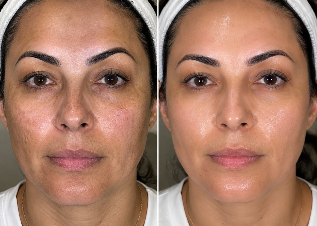 Before and after results showing improved skin tone, texture, and radiance following professional skin rejuvenation treatments